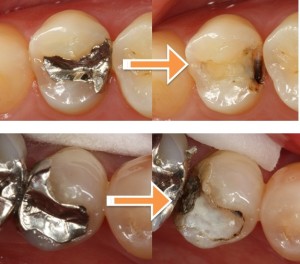 2次むし歯の写真
