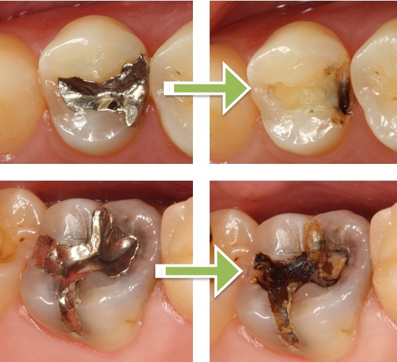 2次むし歯 と 修復サイクル | R.V.TUCKER Study Clubs (タッカー・ゴールド・スタディクラブ)