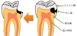 むし歯の進行